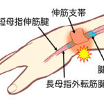 腱鞘炎になりやすい習慣と予防方法とは？